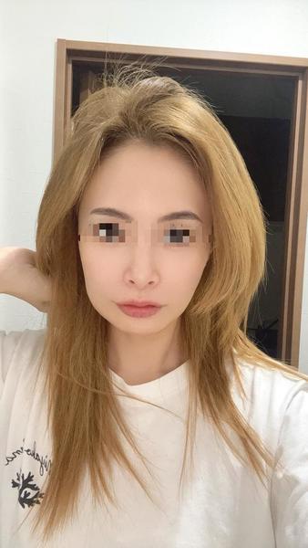 親知らず抜きました